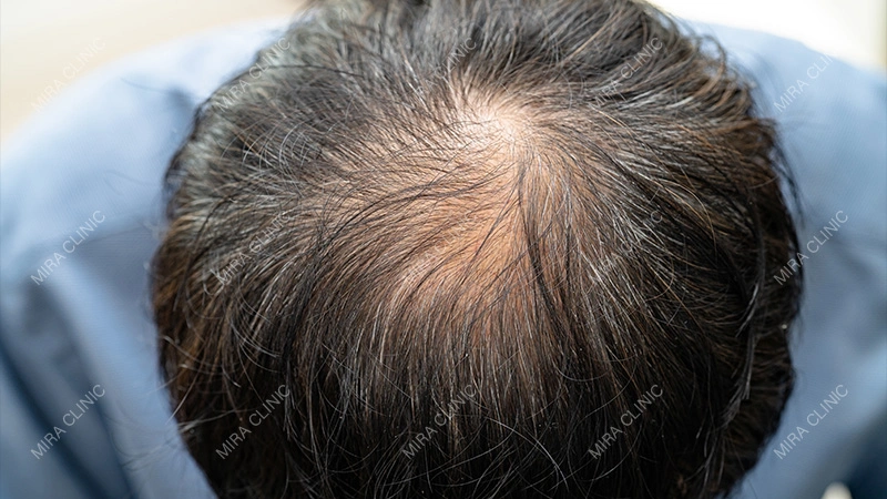 a Good Candidate for DHI Hair Transplant